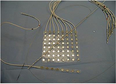 Brain–Computer Interface (BCI) Applications in Mapping of Epileptic Brain Networks Based on Intracranial-EEG: An Update